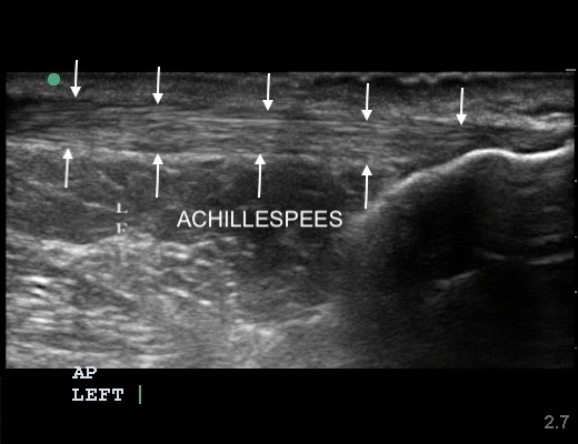 Achillespees links, beeld van een normale pees